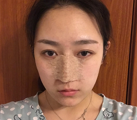 温州小姐姐鼻部多项术后45天带果图分享!