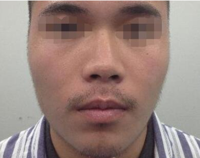 东北国际医院整形美容科自体脂肪填充面部面诊