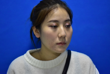 深圳南雅医疗美容面部吸脂术后100天果分享附