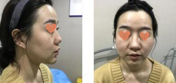 北京炫美医疗美容医生徐学东鼻部手术案例分享！