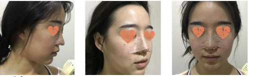 北京炫美医疗美容医生徐学东鼻部手术案例分享！
