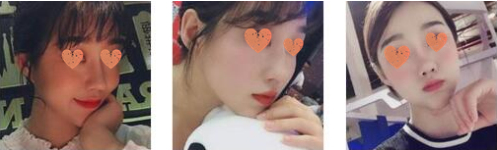 北京炫美医疗美容医生徐学东鼻部手术案例分享！