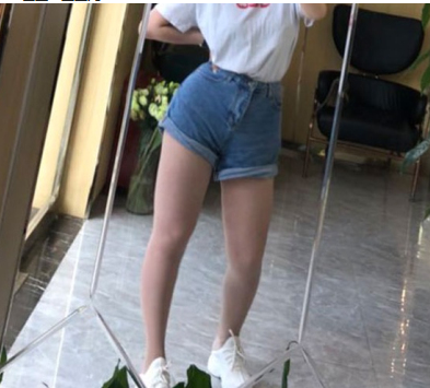 成都医美整形王宝光医生大腿吸脂案例分享!