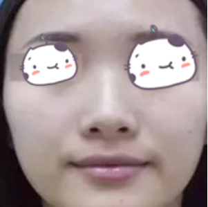 运城丽都医美医生杨顺新鼻部手术案例分享