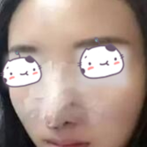 运城丽都医美医生杨顺新鼻部手术案例分享