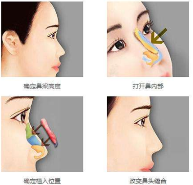 假体隆鼻和自软骨隆鼻如何选择?那个好?