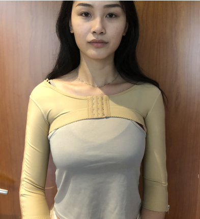 杭州艺星医疗美容手臂吸脂术后90天果分享