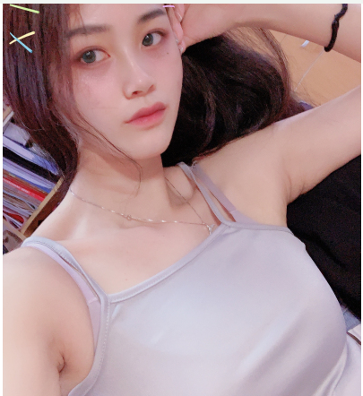 杭州艺星医疗美容手臂吸脂术后90天果分享