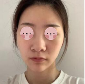 西安俪时代医美整形鼻部手术手术案例分享