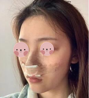 西安俪时代医美整形鼻部手术手术案例分享