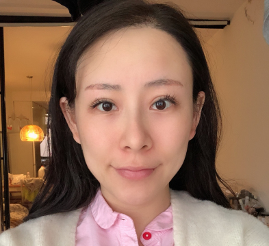 上海爱美者自体脂肪丰额头术后果分享