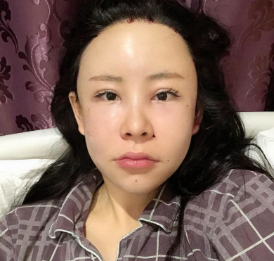 上海爱美者自体脂肪丰额头术后果分享