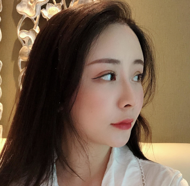 上海爱美者自体脂肪丰额头术后果分享