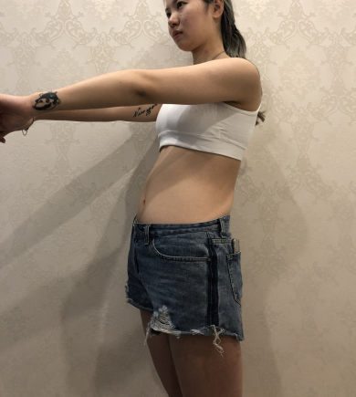 南京美贝尔整形腰腹吸脂案例赏析：恢复果