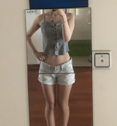 南京美贝尔整形腰腹吸脂案例赏析：恢复果