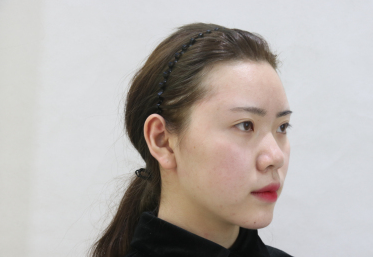 深圳爱美者格美医美黄印资医生埋线提升果分享