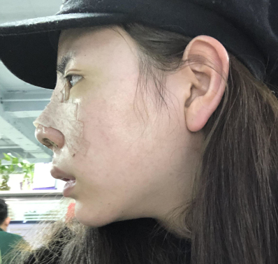 深圳爱美者格美医美黄印资医生埋线提升果分享