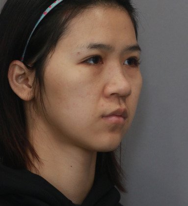 美女在杭州薇琳温科磊医生隆鼻果附图分享