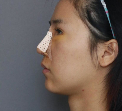 美女在杭州薇琳温科磊医生隆鼻果附图分享