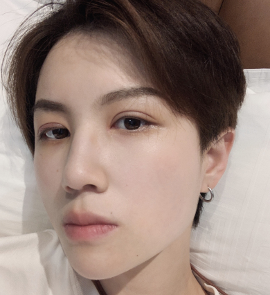 郑州都市风韵医美李广萍医生眼部手术案例分享