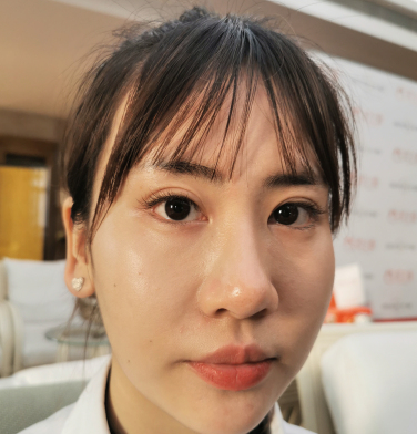 米兰柏羽陈波医师做的隆鼻果分享