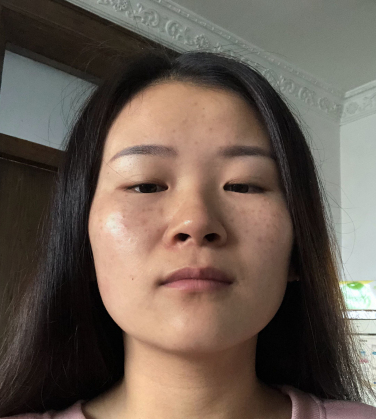 广州佳人医美曹萍医生激光美肤案例附图分享