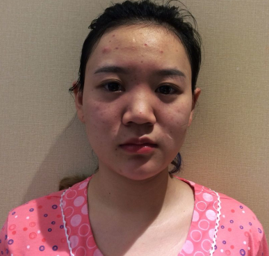 激光美肤祛斑怎样?妹纸佳人医美激光美肤术后分享
