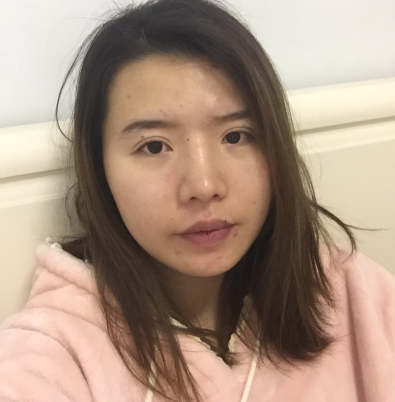 成都MM格莱丽医美光子嫩肤术后果分享