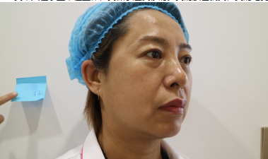 杭州东方整形超激光美肤术后一月果分享