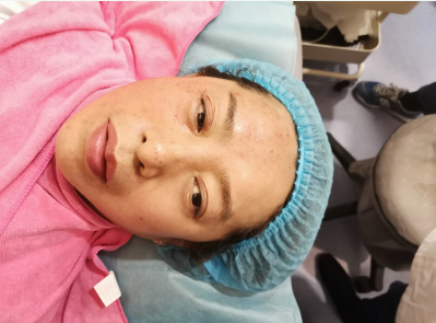 杭州东方整形超激光美肤术后一月果分享