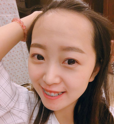 青岛科发源医美好吗?妹纸植发际线带图分享