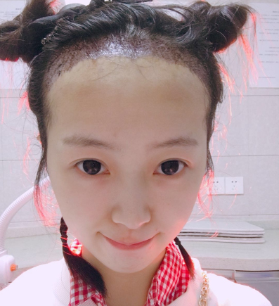 青岛科发源医美好吗?妹纸植发际线带图分享