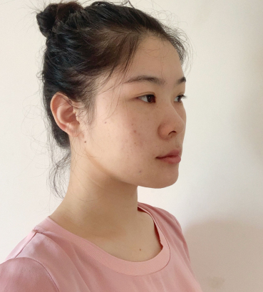 再生未来医美靠谱吗?MM热玛吉术后分享