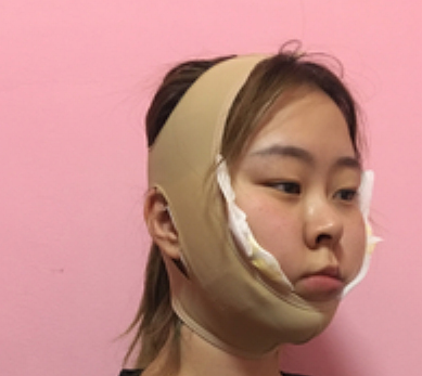 深圳恒丽医美好吗? 王雷吸脂面部果咋样?