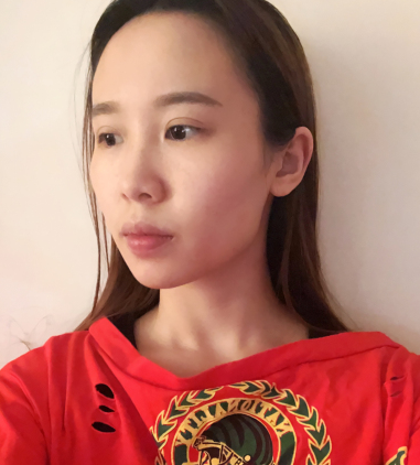 兰州崔大夫整形医生陈萌果酸焕肤果如何？案