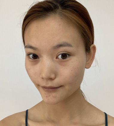 罗日云激光美肤激光果如何 东莞华美实例展示