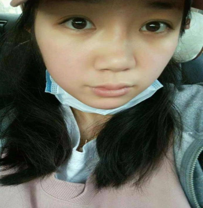 长沙艾依美刘湘做鼻部手术修复怎么样？案例