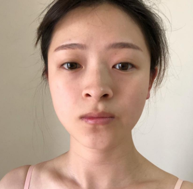 深圳容术方立肋软骨隆鼻怎么样?案例