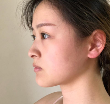 深圳容术方立肋软骨隆鼻怎么样?案例