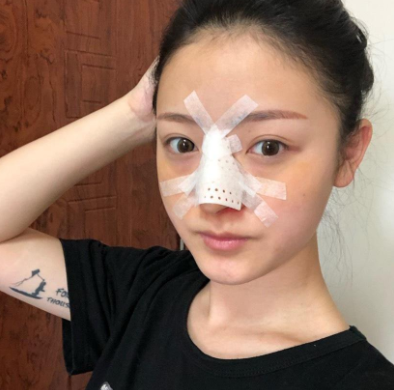 深圳容术方立肋软骨隆鼻怎么样?案例