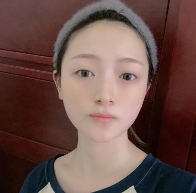 深圳容术方立肋软骨隆鼻怎么样?案例