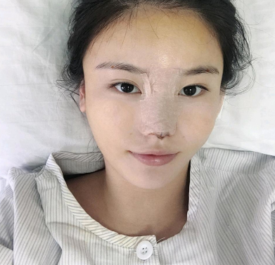 武汉新至美医疗美容聂祝锋医生鼻部手术案例分享