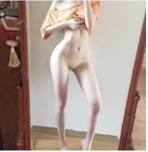 上海华美整形大腿吸脂案例术后两月分享附对比
