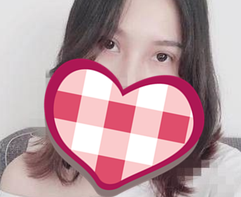 杭州东方整形医院个双眼皮靠谱吗?真实案例