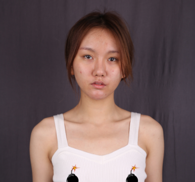 上海华美谢卫国做假体隆胸怎么样?案例