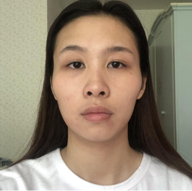 上海仁爱刘先超做下颌角+颧骨内推怎么样?案例