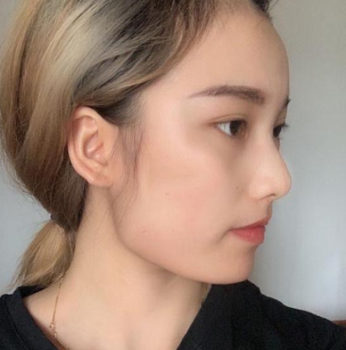 深圳恒生(嘉美)肖添有下颌角磨骨案例分享