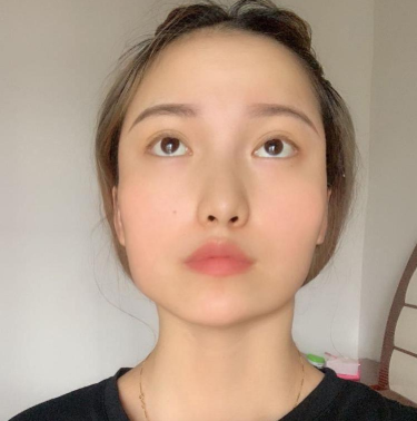 深圳恒生(嘉美)肖添有下颌角磨骨案例分享