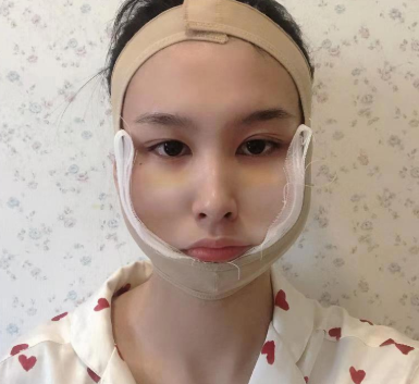 上海仁爱刘先超做下颌角+颧骨内推怎么样?案例
