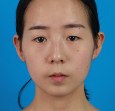 昆明医科大学第二附属医院能做双眼皮吗?案例